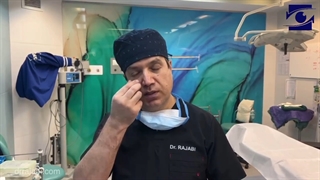 خارج کردن توده های چربی تزریق شده همراه با بلفاروپلاستی پلک پایین