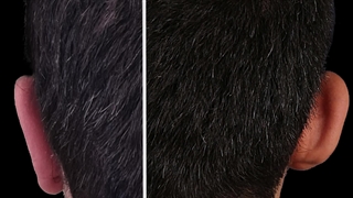 اتوپلاستی (جراحی زیبایی گوش) - بهترین فوق تخصص جراحی پلاستیک و زیبایی