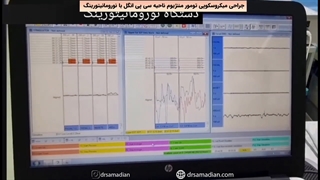 عمل جراحی میکروسکوپی تومور مننژیوم ناحیه سی پی انگل با نورومانیتورینگ