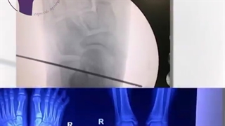 ✅اصلاح همزمان صافی کف پای کودکان به روش آرتروزیس .