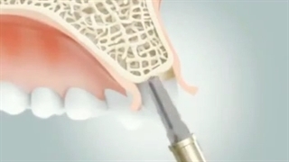درمان بوسیله ایمپلنت دندان