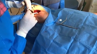 انجام ایمپلنت دندان با ضمنت دندان