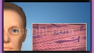 تزریق فیلر بلیچینگ