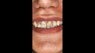 اصلاح طرح لبخند با لمینت سرامیکی ایمکس در اصفهان | دندانپزشکی مهدی کچوئی و راضیه کامران