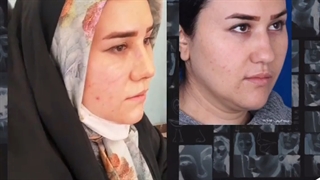 جراحی بینی با شکستگی تیغه بینی-دکتر محمد مهدی سالم