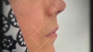 نمونه کار قبل و بعد از رینوپلاستی