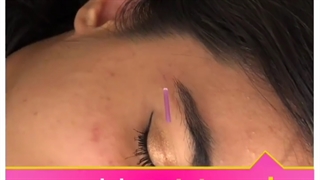 درمان سینوزیت با طب سوزنی