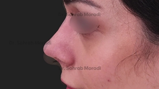 عمل زیبایی بینی - بهترین جراح زیبایی بینی