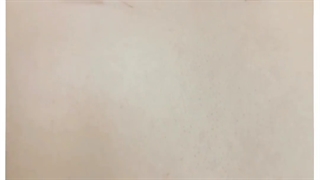 درمان سیاتیک با طب سوزنی