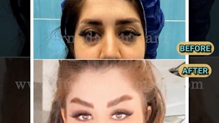 نمونه جراحی های لیفت