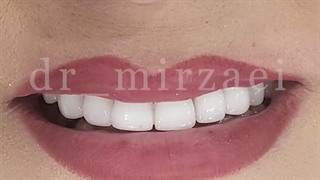 اصلاح طرح لبخند با کامپوزیت | دکتر میرزایی