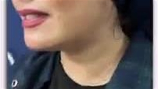 30 روز پس از پروتز چانه و ساکشن گردن