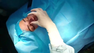 فیلم قبل و بعد جراحی عمل بینی پارت اول