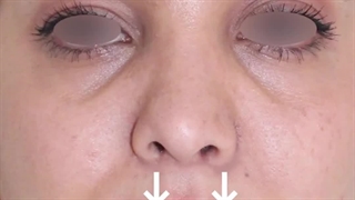 لیفت سانترال لب | دکتر علی الستی