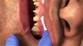 انجام لمینت دندان با قیمت مناسب و منصفانه