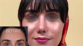 یک ماه و نیم بعد از جراحی بینی