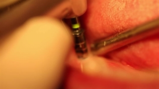 رضایت بیمار از ایمپلنت