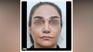 لیفت اندوسکوپی ابرو - بهترین جراح لیفت ابرو در تهران