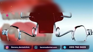 چگونه ارتودنسی نامرئی در دهان جای می گیرد؟