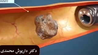 تا حالا سنگ شکنی کلیه انجام دادید؟