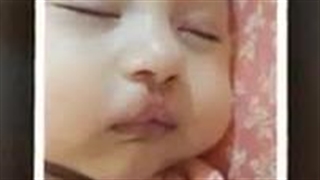 ترمیم شکاف لب دو طرفه