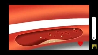 فشار خون و علائم فشار خون بالا