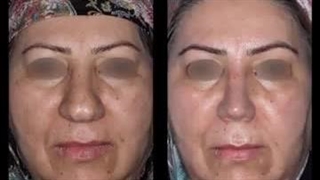 رینوپلاستی بینی گوشتی در میانسالی