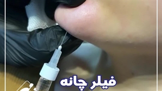 تزریق فیلر چانه بصورت کاملا جوابگو و یک تزریق زیبایی کم نظیر در مرکز زیبایی شادمهر برداشتن زگیل
