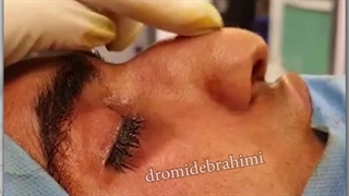 جراحی بینی گوشتی با انحراف بسیار شدید