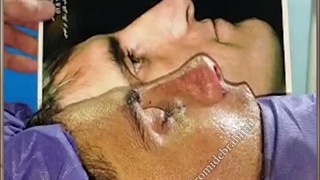 جراحی بینی استخوانی بزرگ و سر پایین