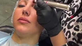 ریموو تاتو قدیمی بدون درد و عوراض