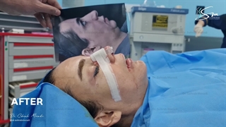 ژنیوپلاستی (جلو کشیدن چانه)، عمل بینی و لیفت اندوسکوپی ابرو _ دکتر سهراب مرادی