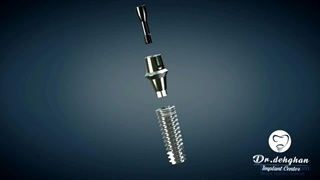 ایمپلنت دندان چگونه انجام می شود؟