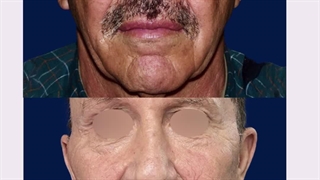 سه سال پس از لیفت صورت