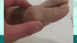 آرتروز شدید مفصل انگشت شصت | دکتر طاهریان