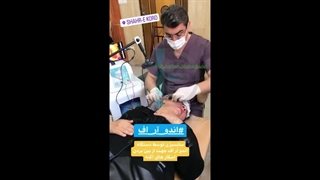 درمان اسکار آکنه با دستگاه پزشکی Endo-RF Subcision