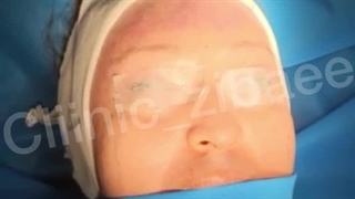 بهترین مرکز تخصصی لیفت صورت در تهران