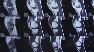 آرتروسکوپی منیسک زانو