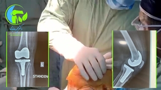 عمل جراحی آرتروز زانو 2