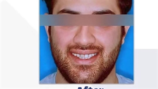 درمان ارتوسرجری و تکمیل آن تنها در 20 ماه