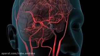 ۸.سکته مغزی