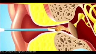 ۲۰.بهداشت گوش
