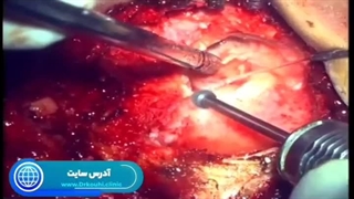 فلج بلز (سندروم بلز)