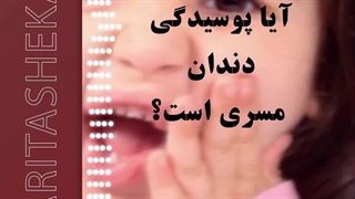 آیا پوسیدگی دندان، مسری است؟