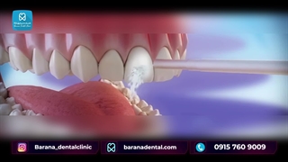 مراحل انجام ارتودنسی دندان