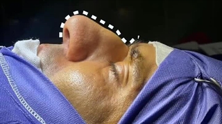 جراحی عمل بینی مردانه