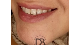 لمینت سرامیکی در زرین شهر