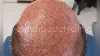 مزوتراپی موی سر بعد از کاشت مو