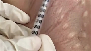 بوتاکس زیر بغل روشی برای کاهش تعریق!