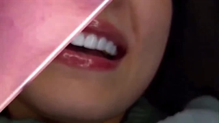 کامپوزیت سرامیکی دندان
